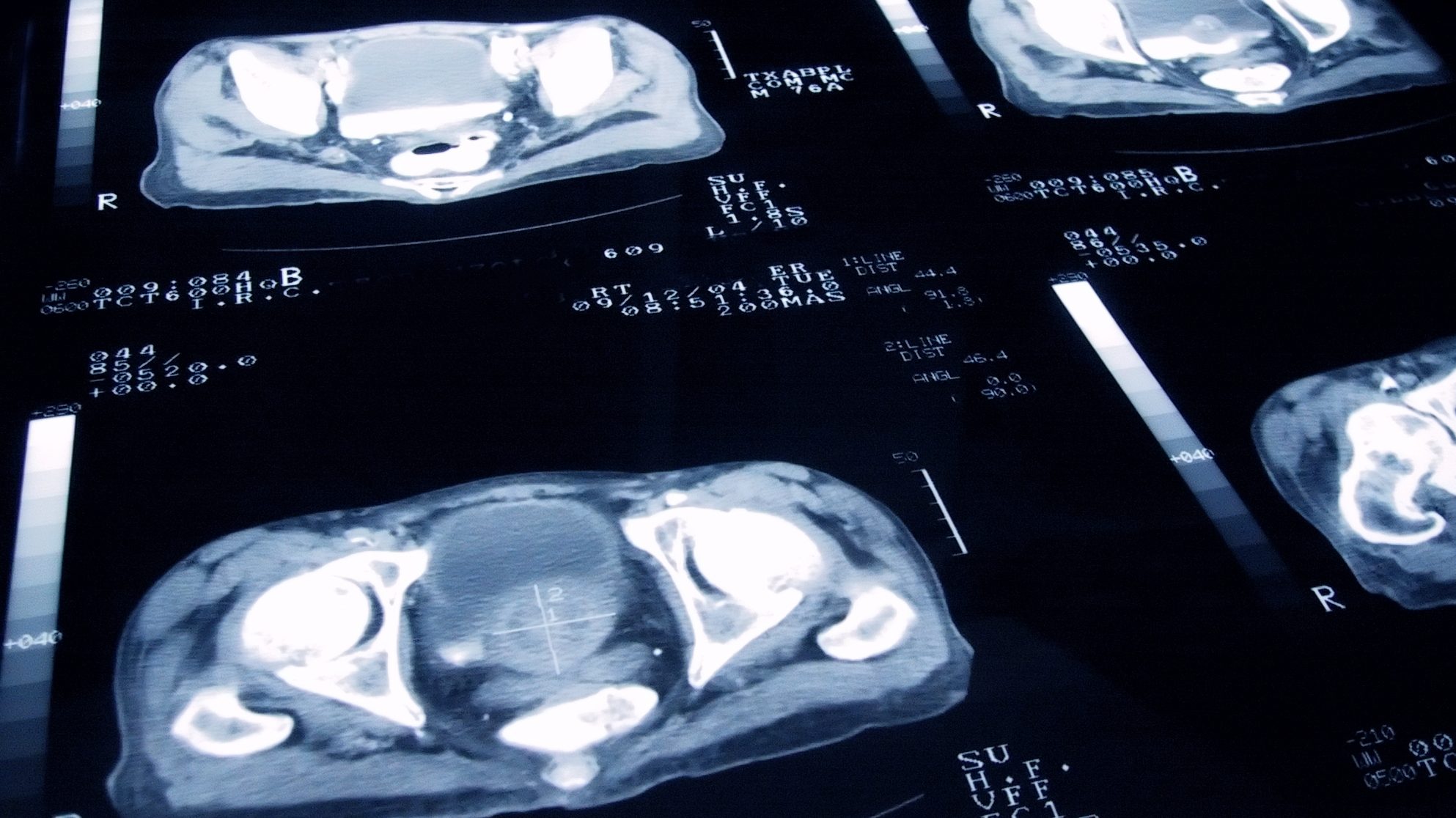Rates Of Metastatic Prostate Cancer Are On The Rise – Are Screening Guidelines To Blame?