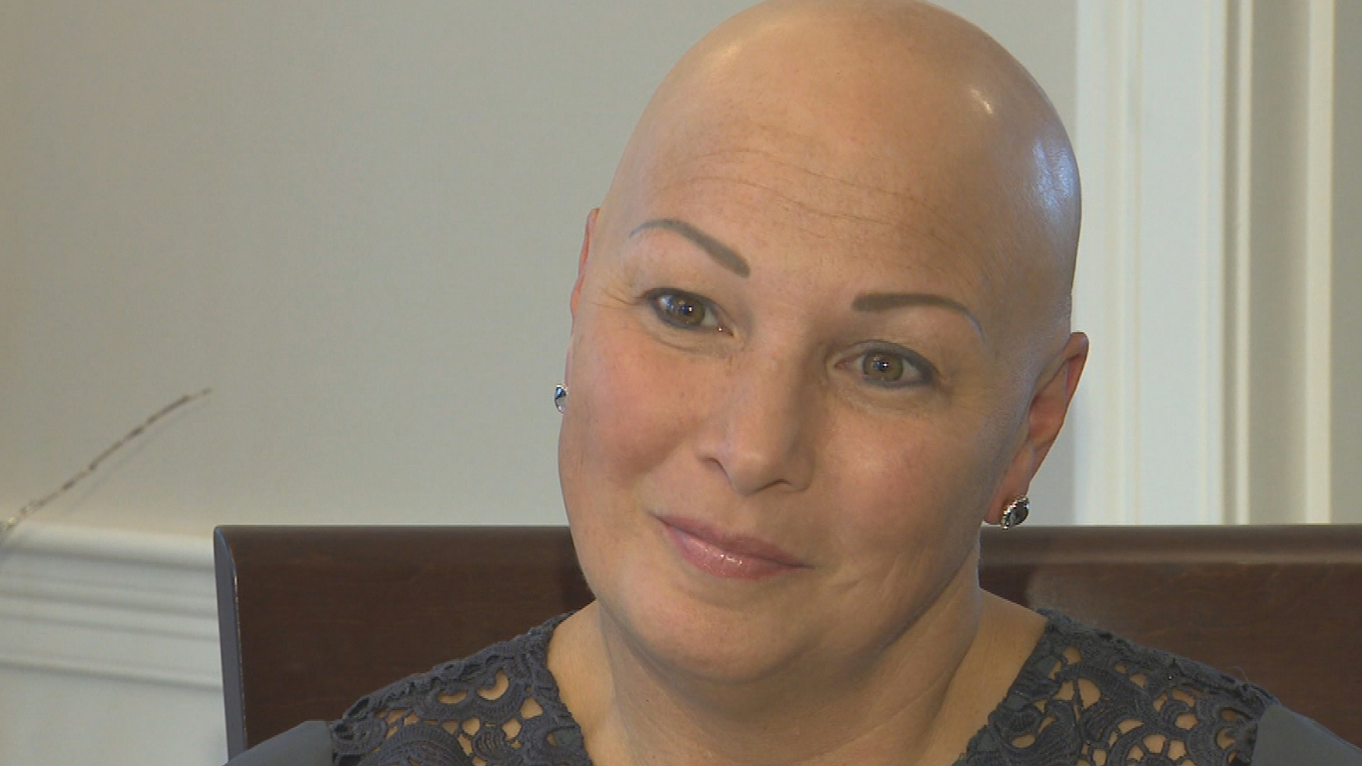 People In Massachusetts Living With Alopecia Hope 'Oscars Slap' Brings  Awareness Of Disease - CBS Boston